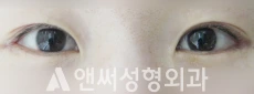 Answer Plastic Surgery case 48: After