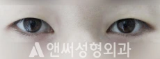 Answer Plastic Surgery case 45: Before
