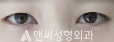 Answer Plastic Surgery case 45: After