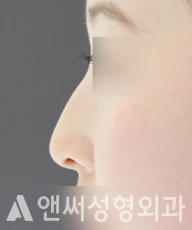 Answer Plastic Surgery case 44: Before