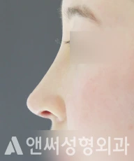 Answer Plastic Surgery case 44: After
