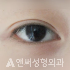 Answer Plastic Surgery case 43: Before