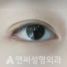 Answer Plastic Surgery case 43: After