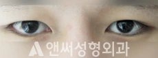 Answer Plastic Surgery case 42: Before
