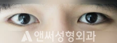 Answer Plastic Surgery case 42: After