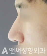 Answer Plastic Surgery case 41: Before
