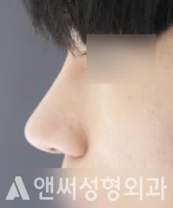 Answer Plastic Surgery case 41: After