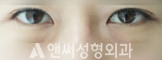 Answer Plastic Surgery case 39: Before