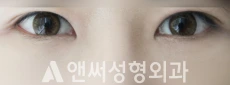 Answer Plastic Surgery case 39: After