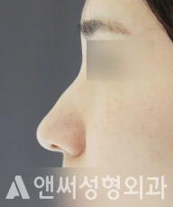 Answer Plastic Surgery case 38: Before