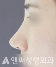 Answer Plastic Surgery case 38: After