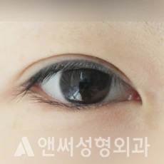 Answer Plastic Surgery case 37: Before