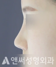 Answer Plastic Surgery case 35: Before