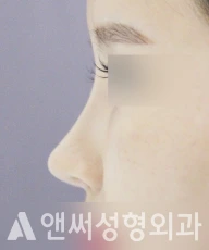 Answer Plastic Surgery case 35: After