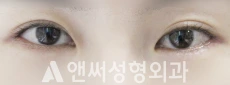 Answer Plastic Surgery case 34: After