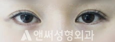 Answer Plastic Surgery case 33: Before