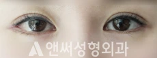 Answer Plastic Surgery case 33: After