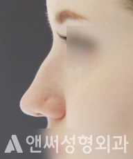 Answer Plastic Surgery case 32: Before