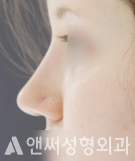 Answer Plastic Surgery case 32: After