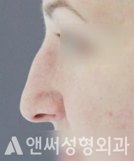 Answer Plastic Surgery case 31: Before