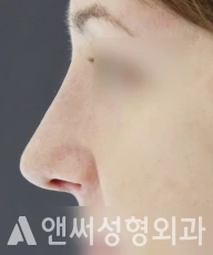 Answer Plastic Surgery case 31: After