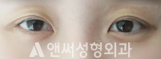 Answer Plastic Surgery case 30: Before