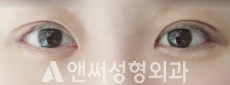 Answer Plastic Surgery case 30: After
