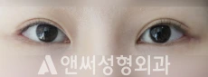 Answer Plastic Surgery case 29: After