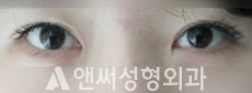 Answer Plastic Surgery case 28: Before