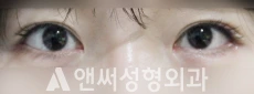 Answer Plastic Surgery case 28: After