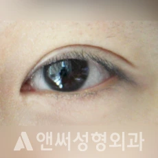 Answer Plastic Surgery case 27: Before
