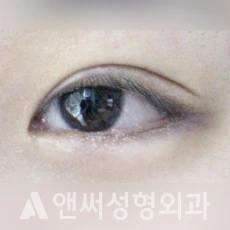Answer Plastic Surgery case 27: After