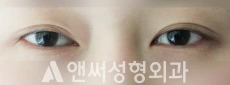 Answer Plastic Surgery case 26: Before