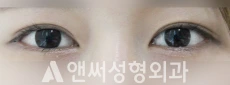 Answer Plastic Surgery case 26: After