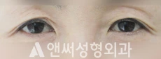 Answer Plastic Surgery case 25: Before