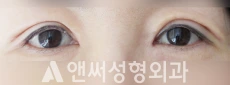 Answer Plastic Surgery case 25: After