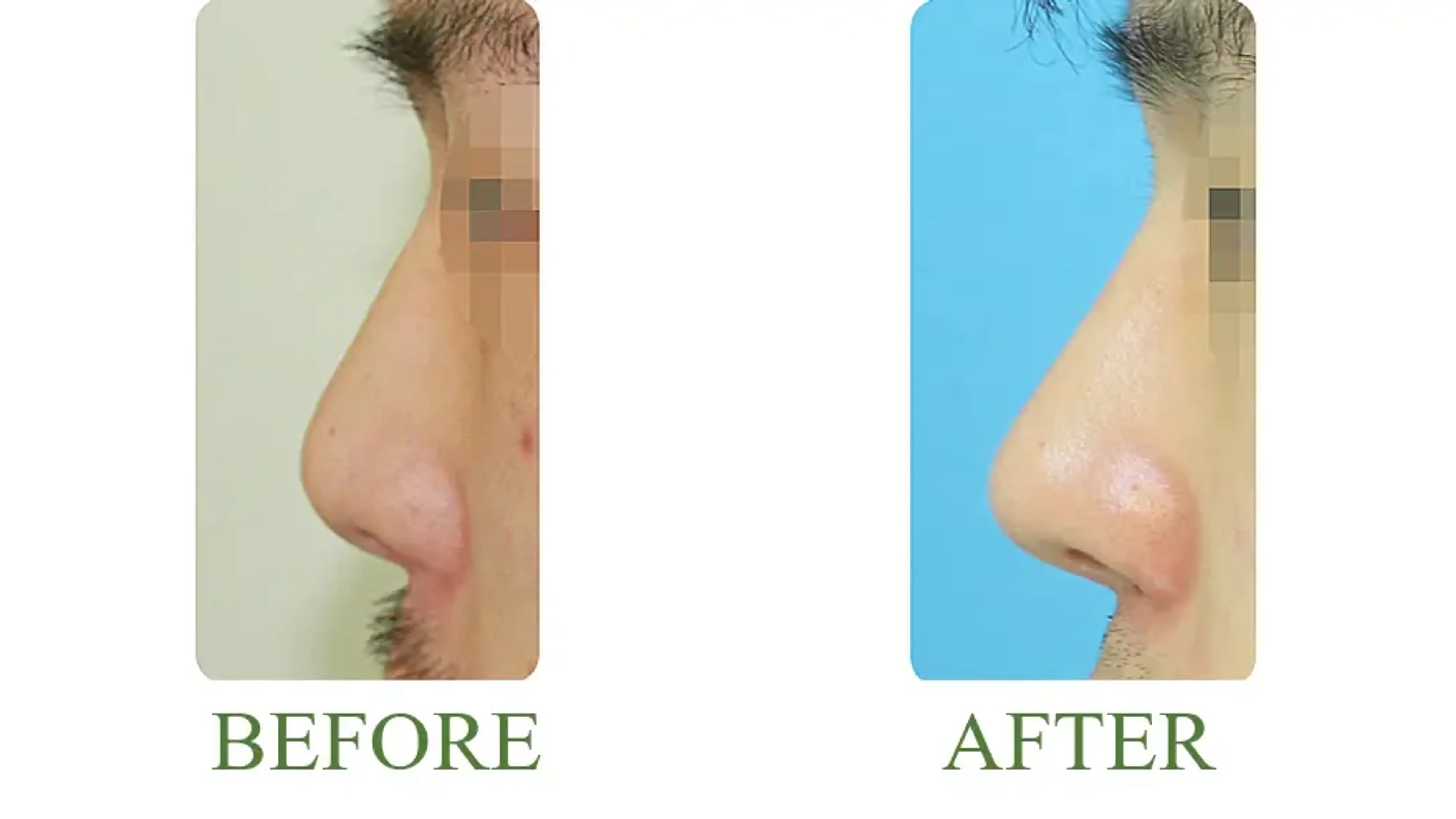 Good-Line Plastic Surgery, clinic-published before and after comparison 12