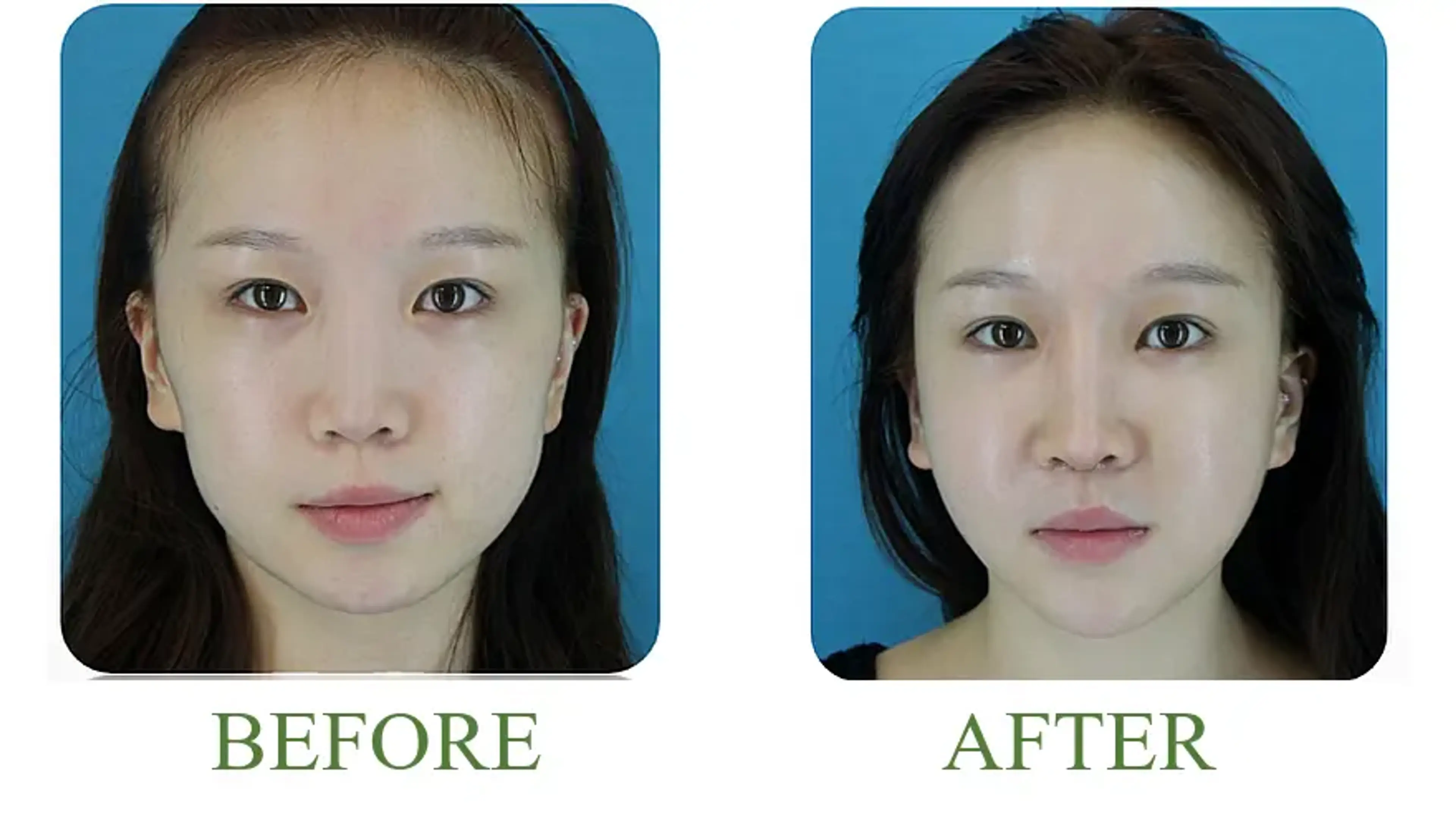 Good-Line Plastic Surgery, clinic-published before and after comparison 3