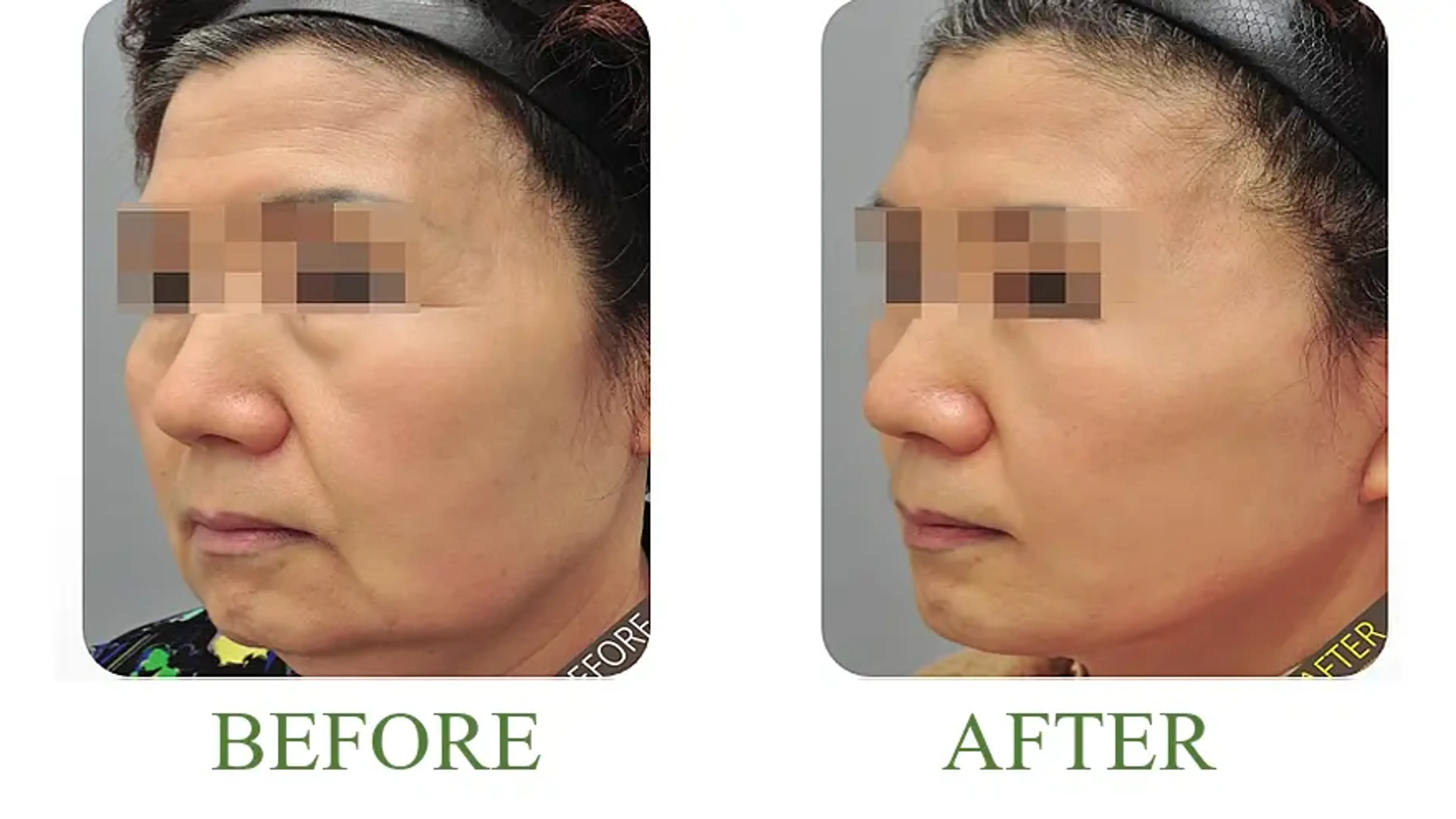 Good-Line Plastic Surgery, clinic-published before and after comparison 4