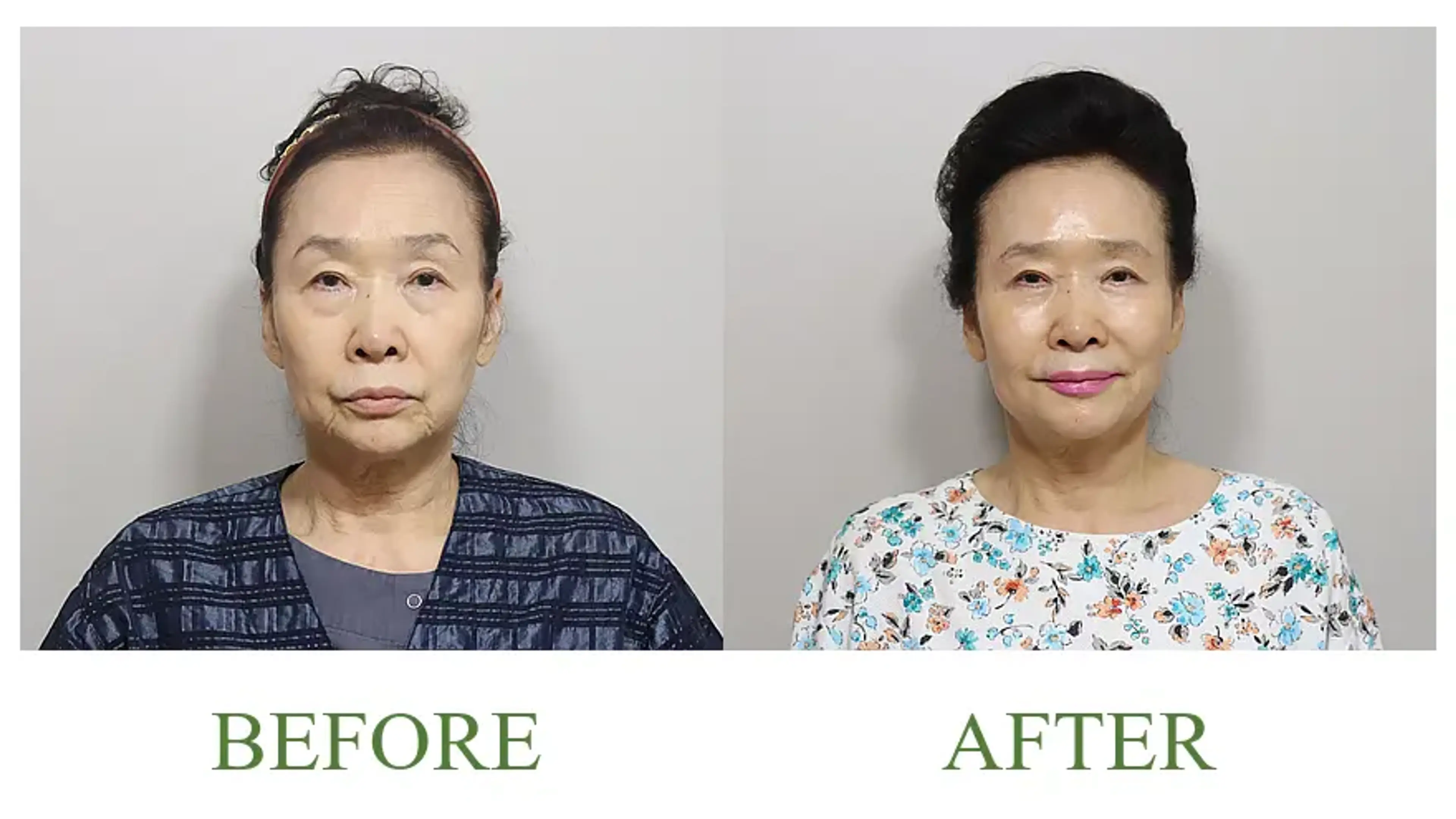 Good-Line Plastic Surgery, clinic-published before and after comparison 5