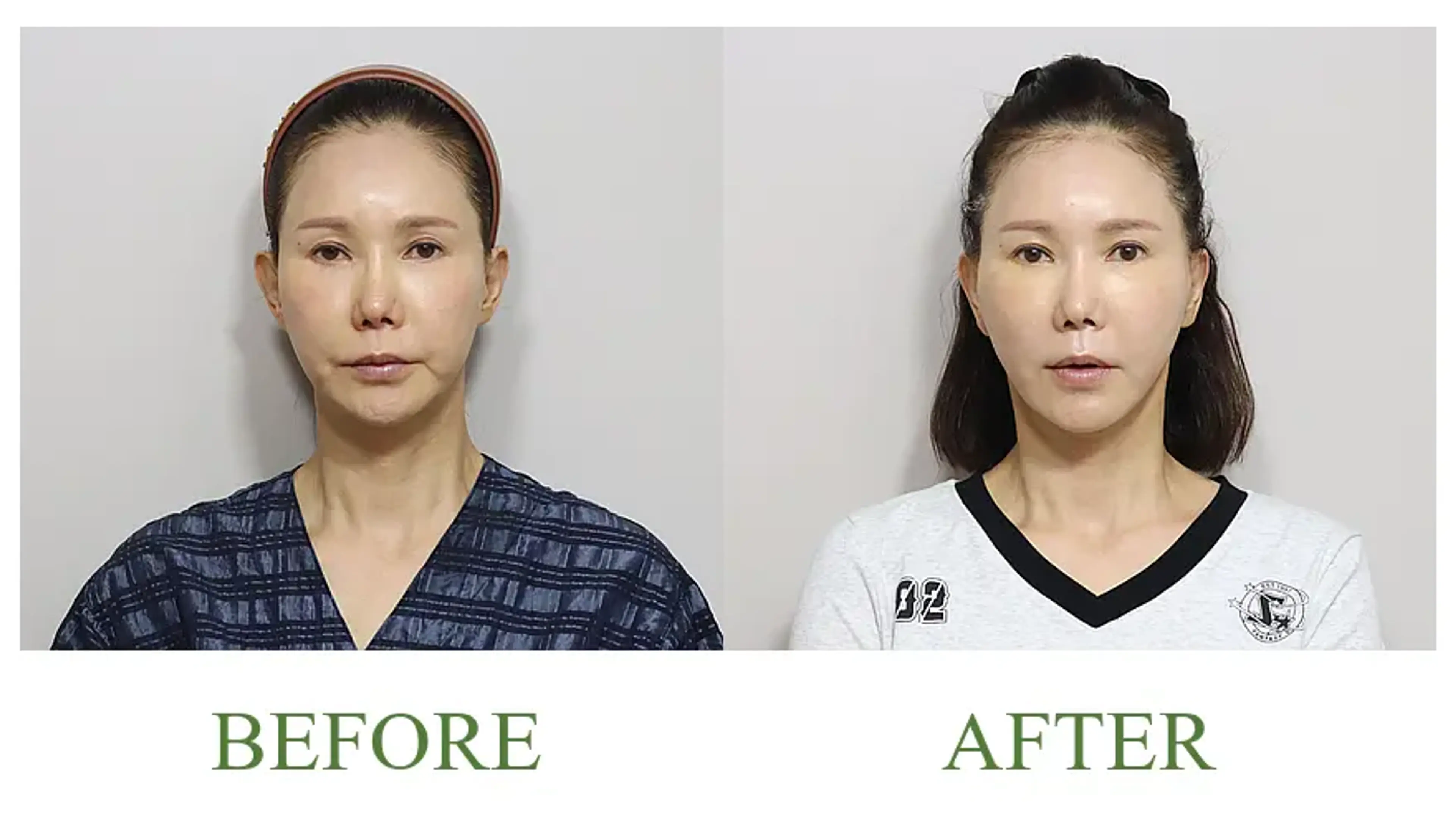 Good-Line Plastic Surgery, clinic-published before and after comparison 6