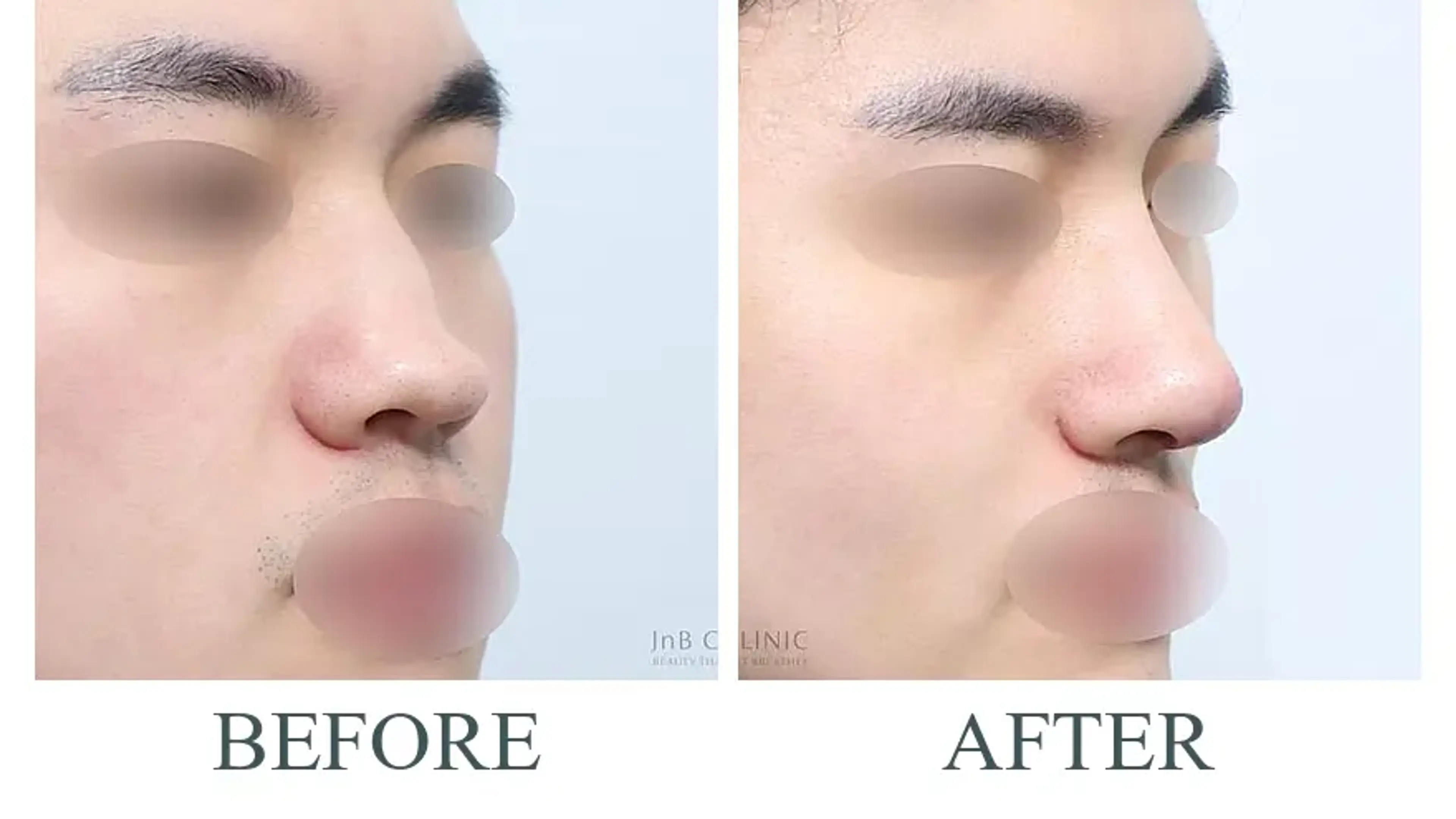 JNB Clinic, clinic-published before and after comparison 1