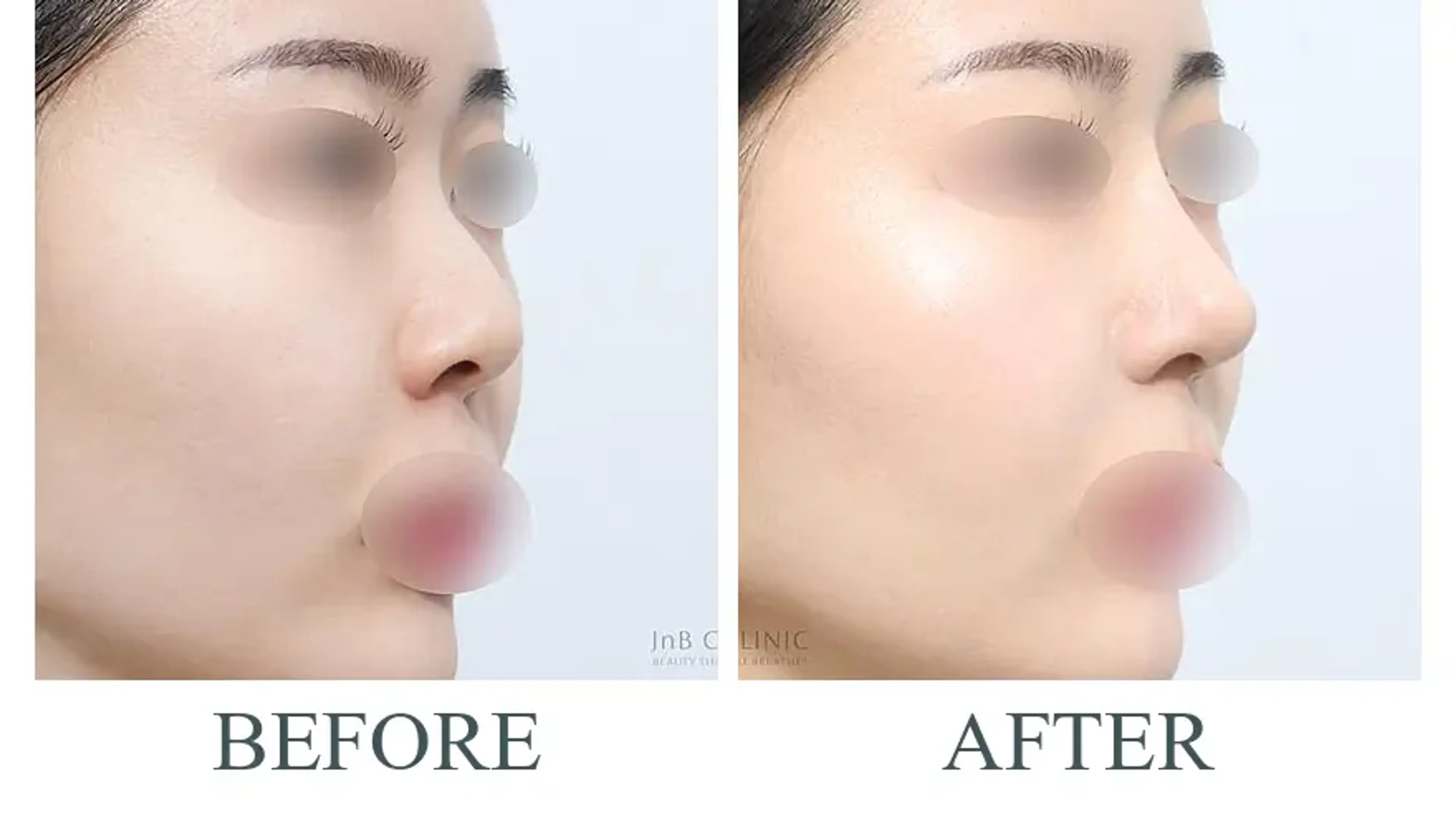 JNB Clinic, clinic-published before and after comparison 2