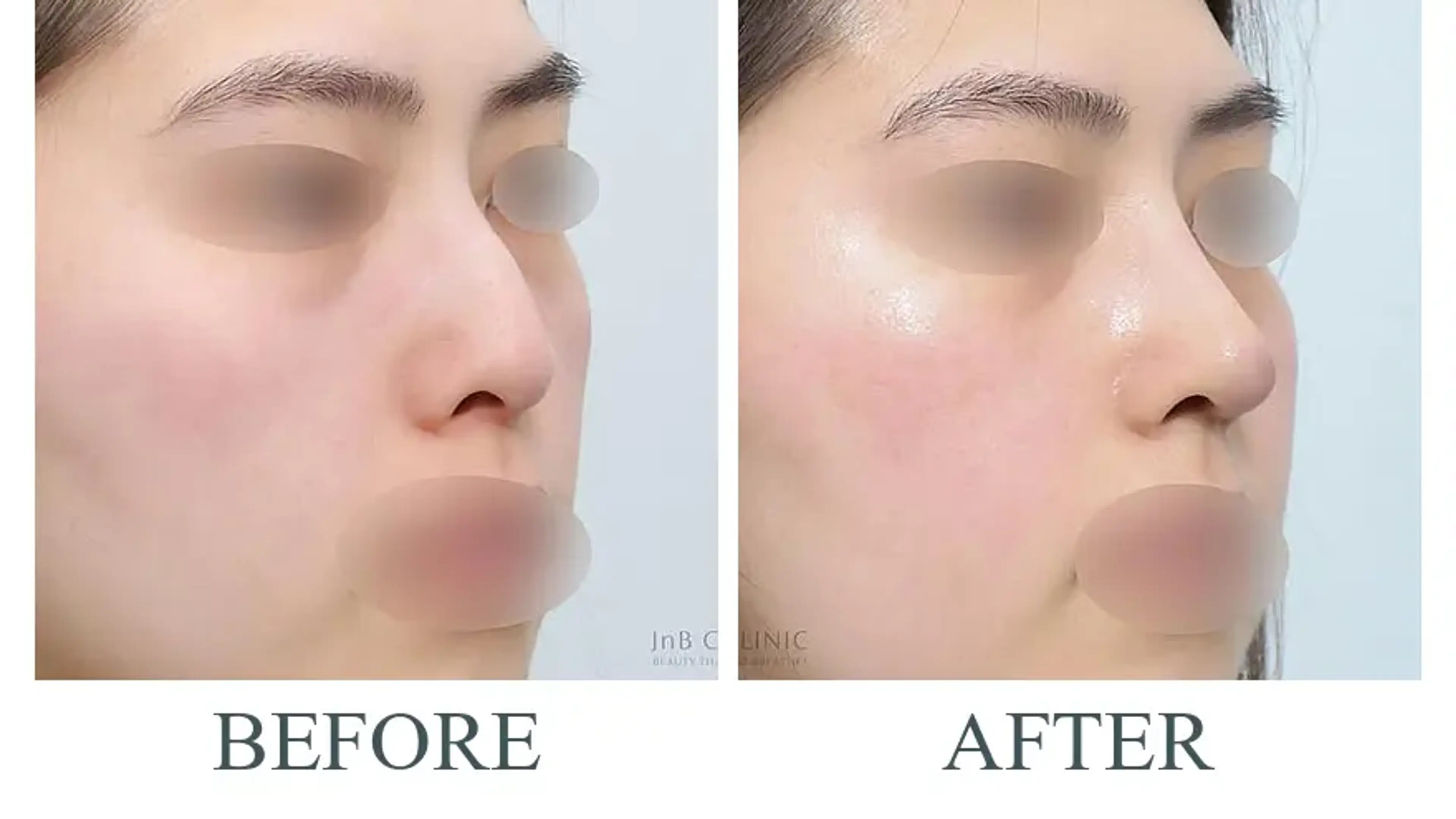 JNB Clinic, clinic-published before and after comparison 3