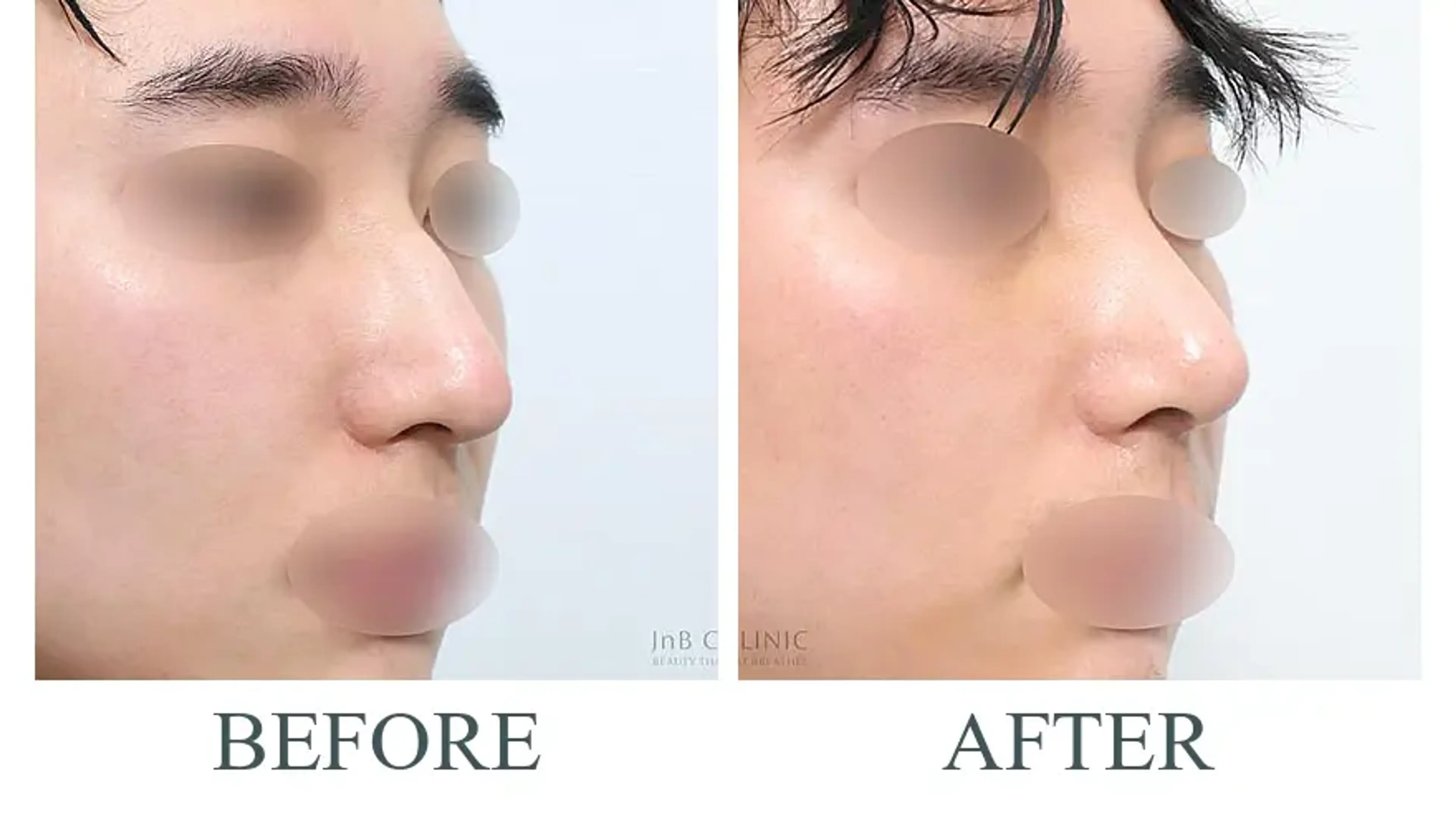JNB Clinic, clinic-published before and after comparison 4
