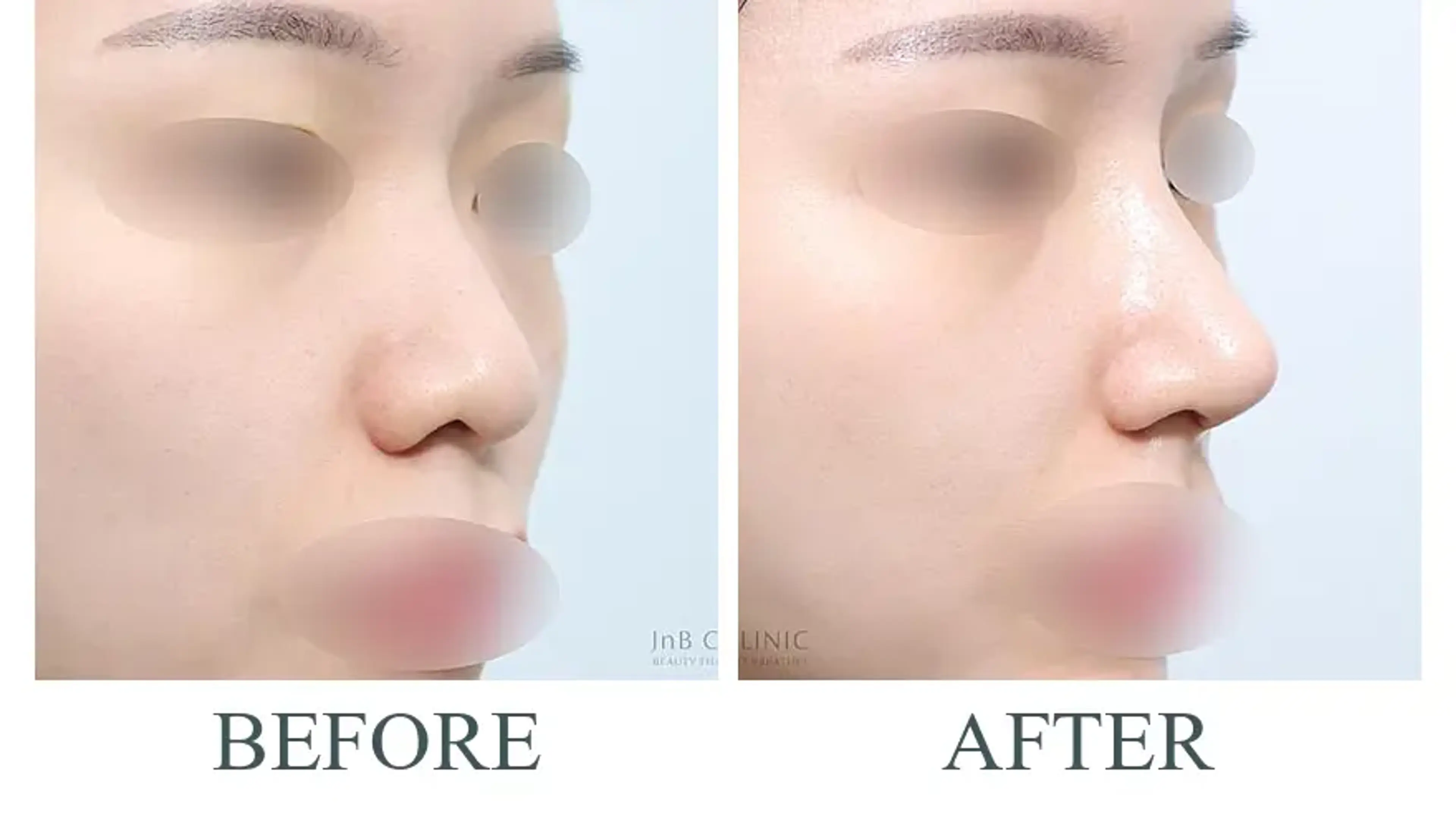 JNB Clinic, clinic-published before and after comparison 5