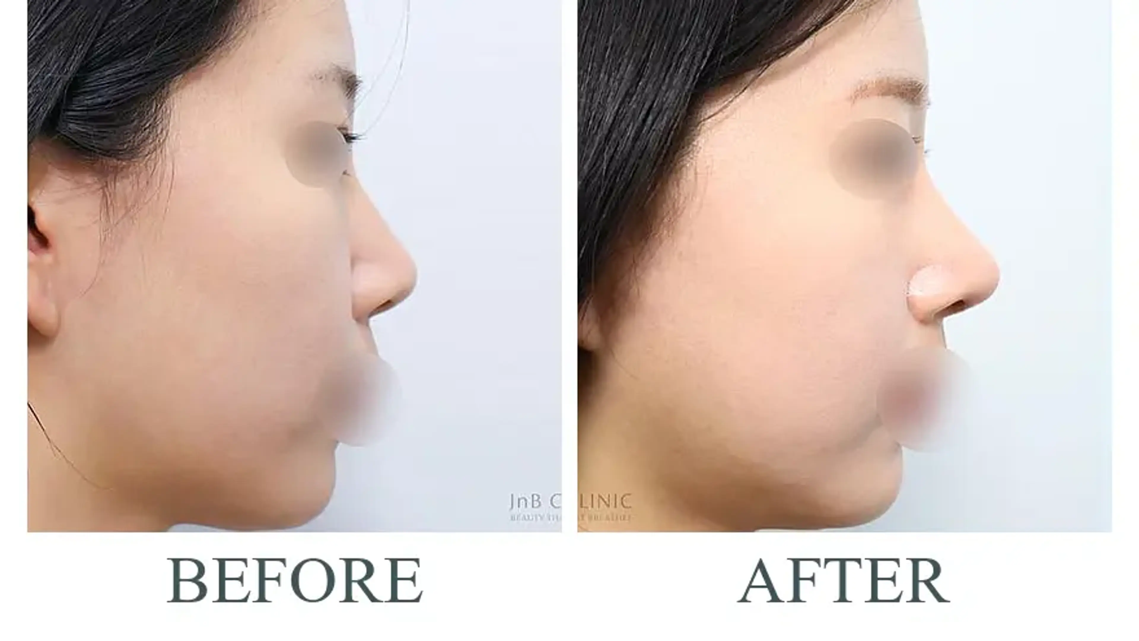 JNB Clinic, clinic-published before and after comparison 6