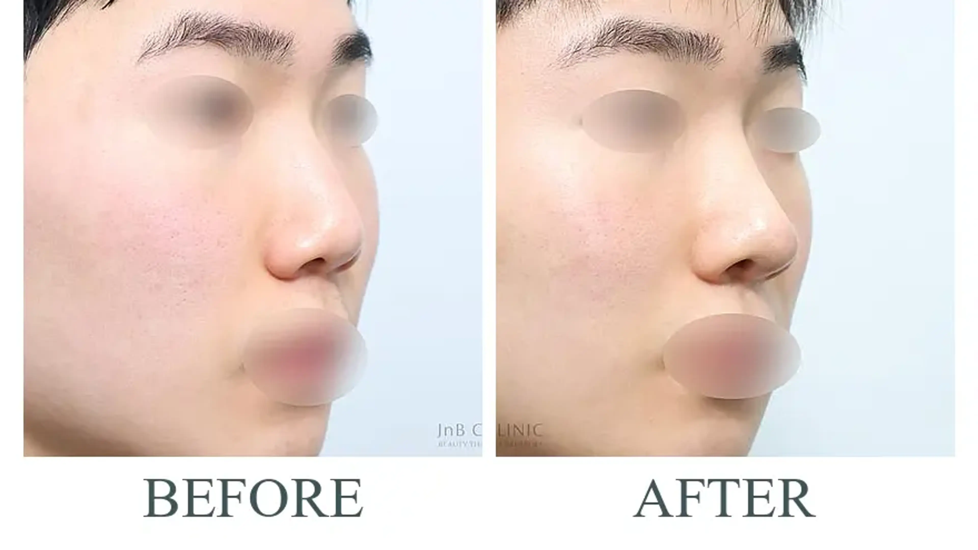 JNB Clinic, clinic-published before and after comparison 7