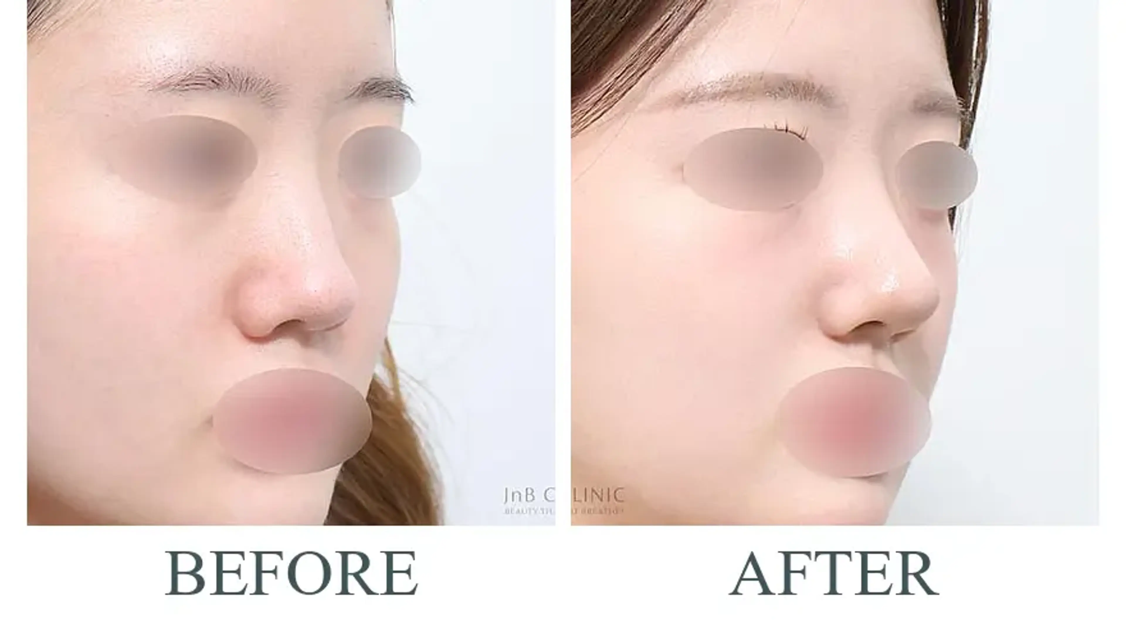 JNB Clinic, clinic-published before and after comparison 8